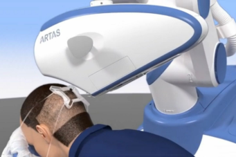 ロボットを使うARTAS（アルタス）植毛のメリットとデメリット