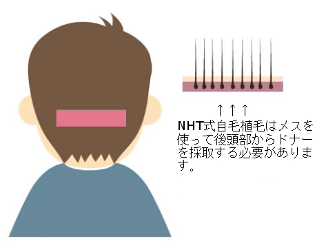 NHT式自毛植毛はFUT法で手術します。